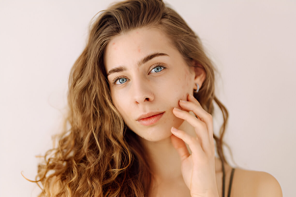 Best Acne Scar Treatment in South Mumbai