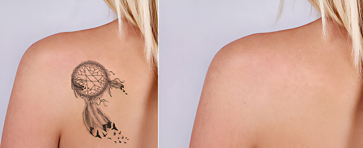 Best Tattoo Removal Treatment in South Mumbai