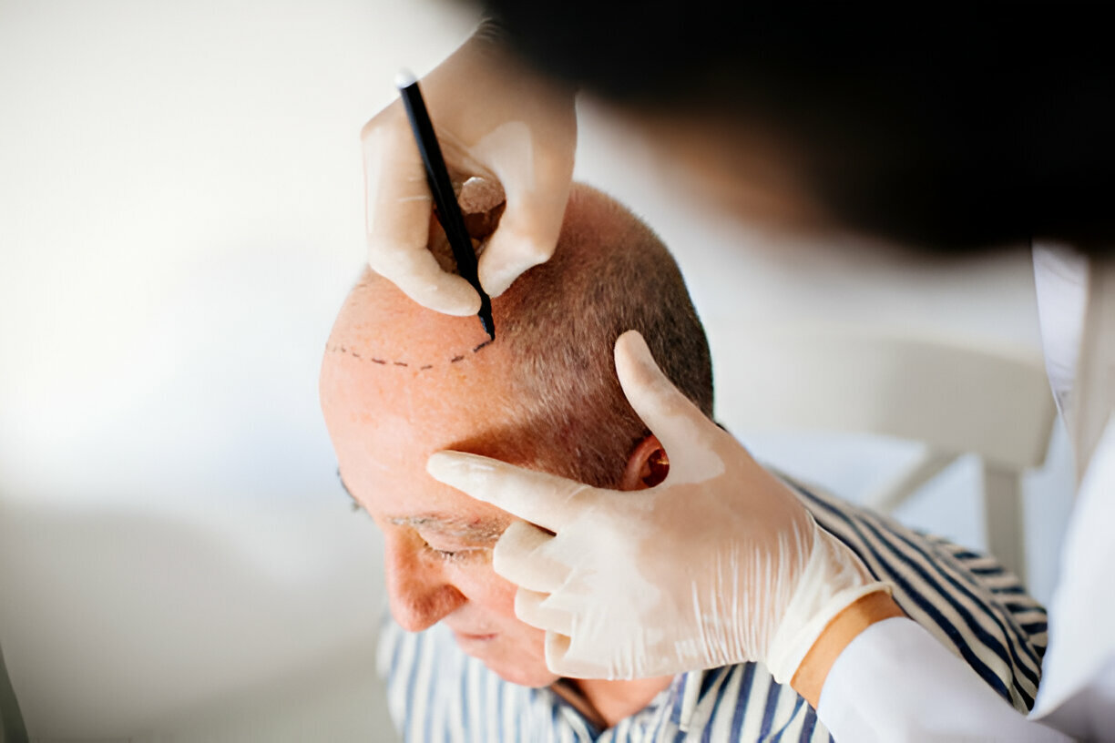 Best Hair Transplant Treatment in South Mumbai