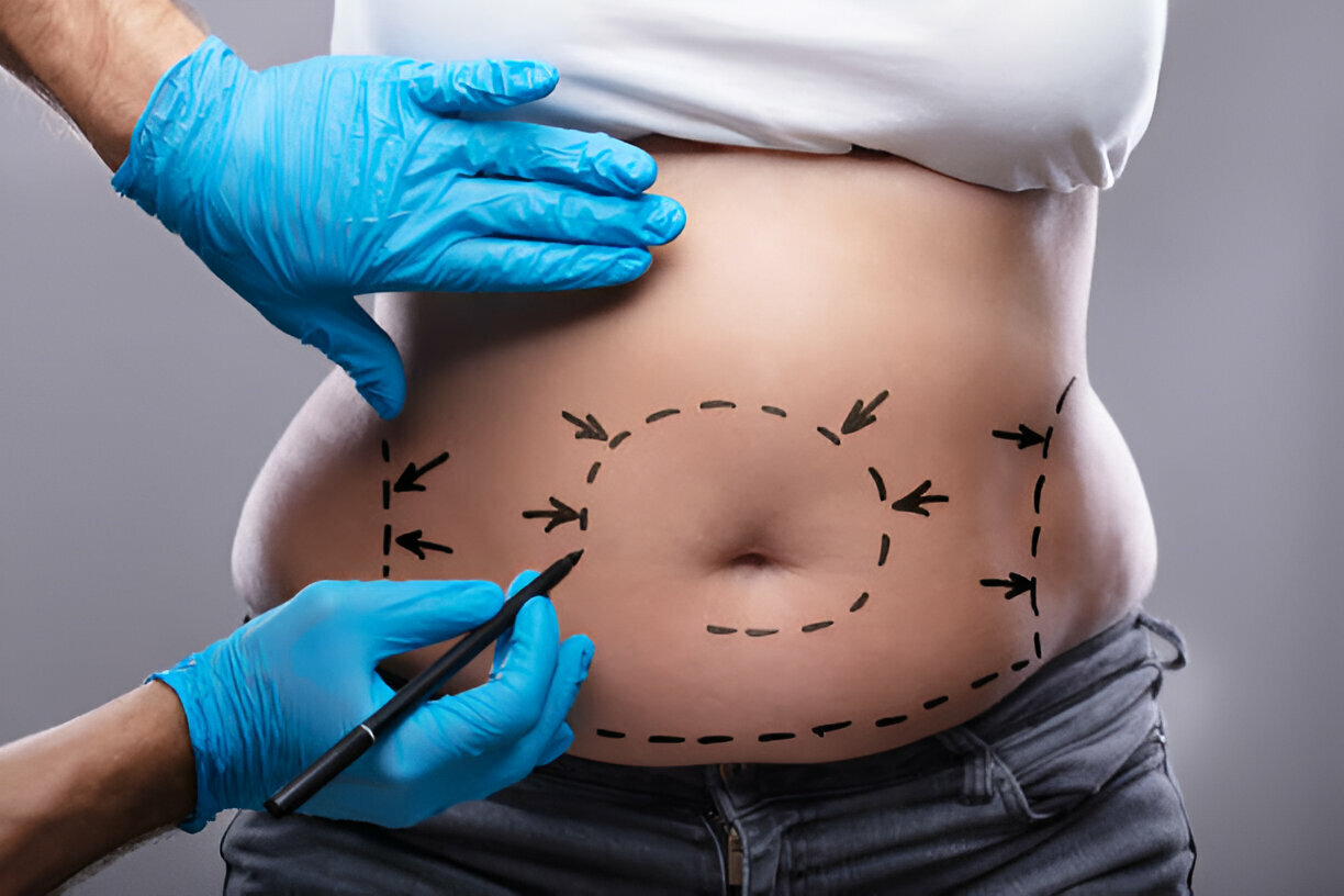Best Liposuction Surgeon in South Mumbai