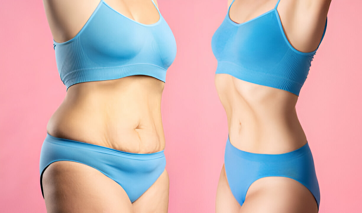 Best Tummy Tuck Surgeon in South Mumbai